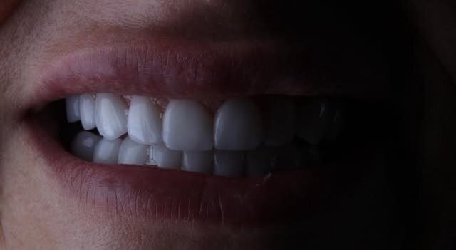 Sorriso com laminados cerâmicos finalizados